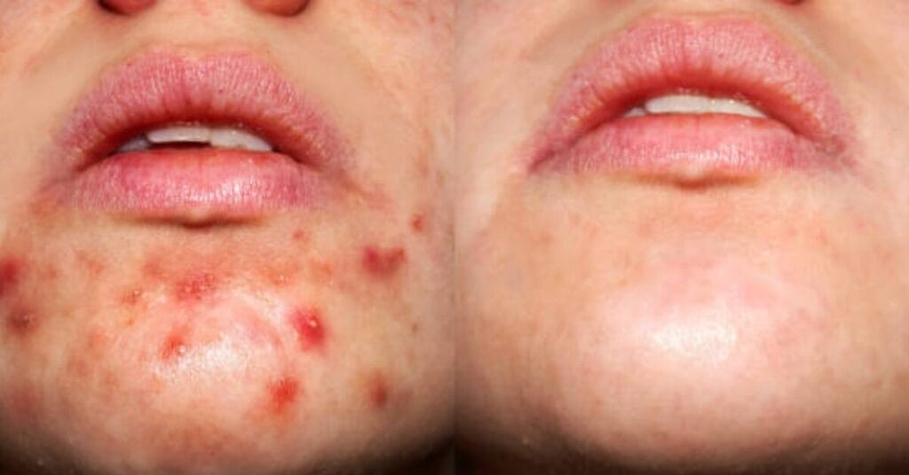 What is inside a Pimple?